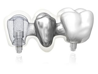 Createch CoCr Abutment