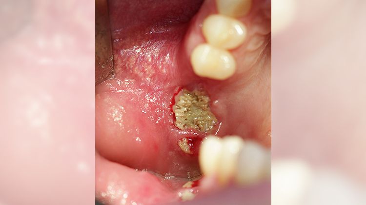 Fig. 1 Initial situation right posterior maxilla, augmentation elsewhere with autologous bone, dehiscence and total loss of the block