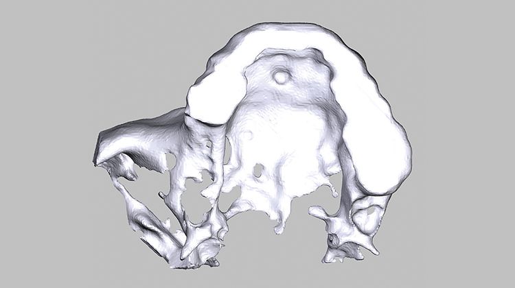Fig. 2 Simulation of the block in the model: The extent of the bone defect in region 16, 17 is clearly apparent.