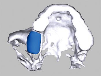 Abb. 3: Simulation des Blocks im Modell: Das Ausmass des Knochendefekts regio 16, 17 ist deutlich zu erkennen.