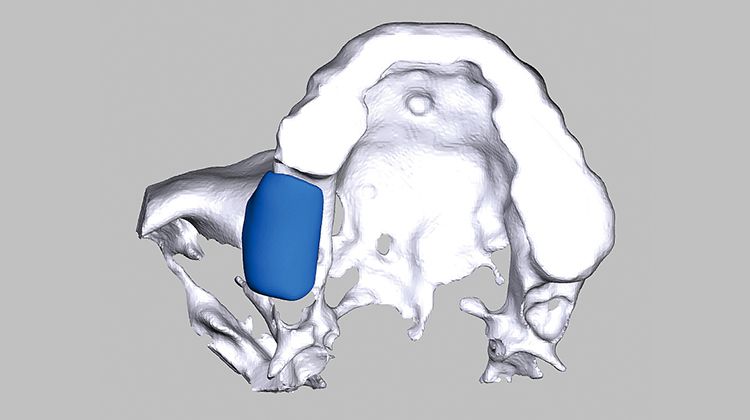 Fig. 3 Simulation of the block in the model: The extent of the bone defect in region 16, 17 is clearly apparent.