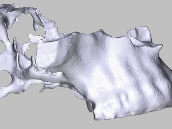 Abb. 4: Simulation des Blocks im Modell: Das Ausmass des Knochendefekts regio 16, 17 ist deutlich zu erkennen.