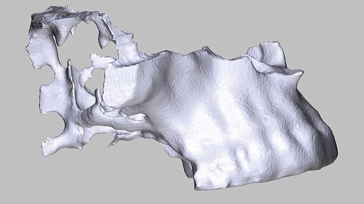 Fig. 4 Simulation of the block in the model: The extent of the bone defect in region 16, 17 is clearly apparent.