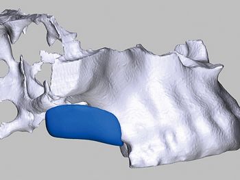 Abb. 5: Simulation des Blocks im Modell: Das Ausmass des Knochendefekts regio 16, 17 ist deutlich zu erkennen.
