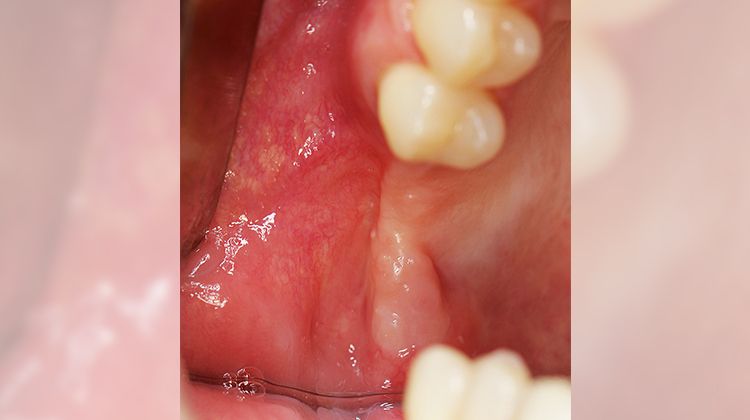 Fig. 6 Clinical situation before reconstruction: very little keratinized mucosa, much mobile mucosa.