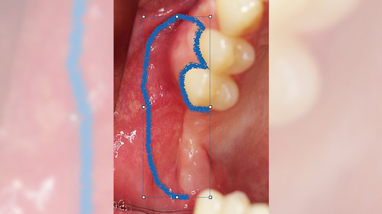 Fig. 7 Pillar incision pattern far in the vestibulum, flap is mobilized towards palatine and translocated.