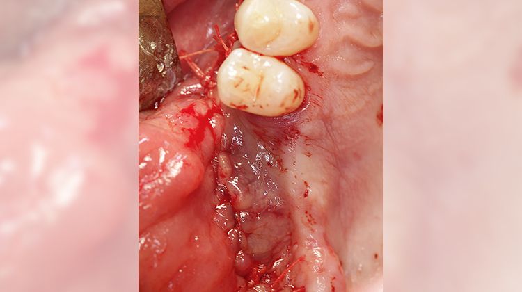 Fig. 11 After wound closure