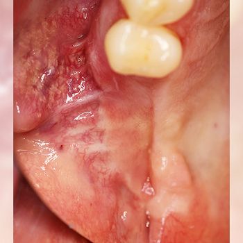 Abb. 12: Klinische Situation nach sechs Monaten. Das Verblüffende: Auf der knöchernen Unterlage des rekonstruierten Alveolarkamms scheint sich neue keratinisierte Schleimhaut zu bilden
