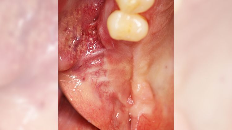 Fig. 12 Clinical situation after six months. The amazing thing: New keratinized mucosa appears to form on the bony underlay of the reconstructed alveolar ridge.