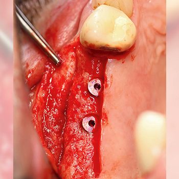 Abb. 13: Einbringen von zwei Implantaten über crestale Schnittführung, der Knochen ist volumenstabil geblieben und vital.