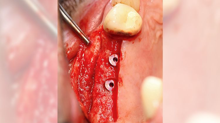 Fig. 13 Introduction of two implants via crestal incision, the bone has remained stable in volume and vital.