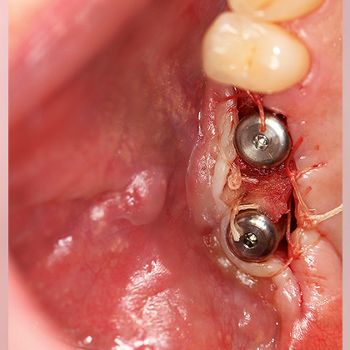 Abb. 14: Nach drei Monaten erfolgt das Freilegen der Implantate.