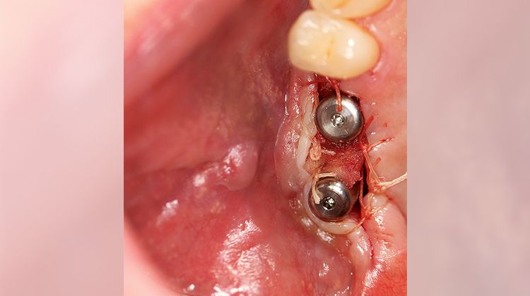 Fig. 14 After three months the implants are exposed.