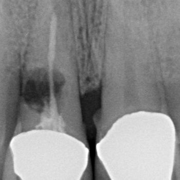 Abb. 9: Zahn 11 ist aufgrund einer Wurzelresorption nicht zu erhalten. 