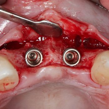 Abb. 1: Implantate wurden regio 11, 21 nach prothetischen Gesichtspunkten inseriert. Aufgrund eines lokalisierten horizontalen Alveolarkammdefektes ist das koronale Drittel der Implantate bukkal exponiert.