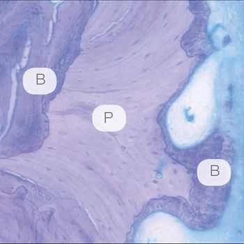 Abb. 7: Histologie von maxgraft® fünf Monate nach Implantation. Der allogene Partikel (P) zeichnet sich durch fehlende Osteozyten und zirkuläre Resorptionsbereiche aus. Erfolgreiche Integration des Allografts im neu gebildeten Knochen (B)