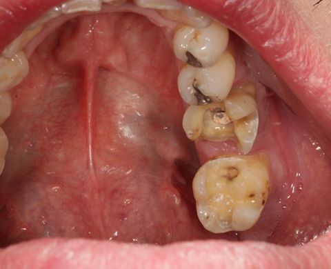Abb. 5: Die präparierten Zähne sind für das intraorale Digitalisieren (Intraoralkamera) vorbereitet. 