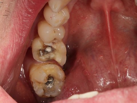 Abb. 6: Die präparierten Zähne sind für das intraorale Digitalisieren (Intraoralkamera) vorbereitet. 
