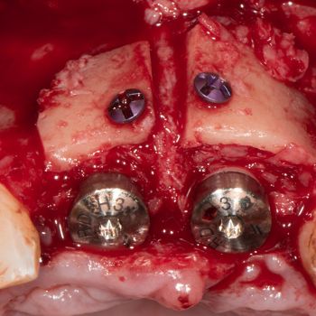Abb. 10: Intraoperativer Situs nach Auffüllung des Spalts zwischen den Implantatoberflächen und den fixierten Knochenblöcken mit autologen Knochenspänen.