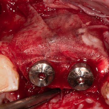 Abb. 11: Intraoperativer Situs nach Abdeckung der Knochenaugmentate mit einer resorbieren Kollagenmembran (Jason membrane, Botiss Biomaterials).