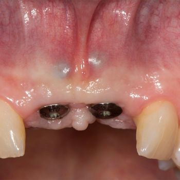 Abb. 13: Klinische Situation 16 Wochen nach Implantation.