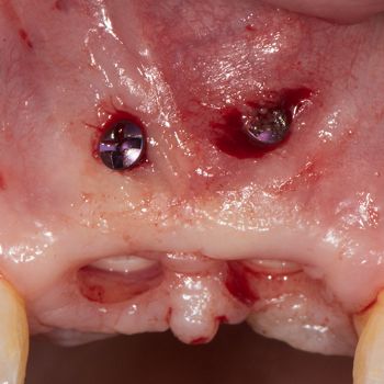 Abb. 14: Klinische Situation 16 Wochen nach Implantation. Stichinzision und Entfernung der Osteosyntheseschrauben.