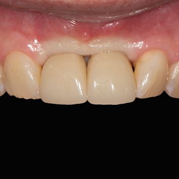 Abb. 15: Klinische Situation 17 Wochen nach Implantation. Laborgefertigte, verschraubte Langzeitprovisorien in regio 11 und 21 zur Ausformung des periimplantären Weichgewebes. Anämischer periimplantärer Schleimhautbereich unmittelbar nach dem Einsetzen der provisorischen Kronen.