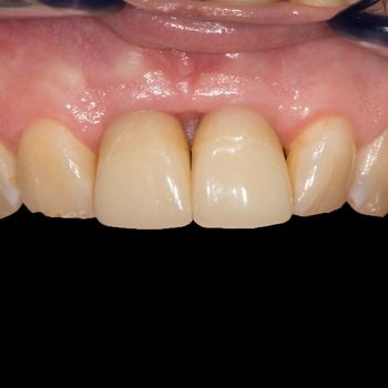 Abb. 16: Klinische Situation 24 Wochen nach Implantation und Ausformung der periimplantären Weichgewebsverhältnisse