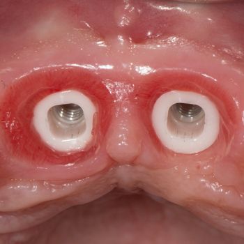 Abb. 17: Klinische Situation 24 Wochen nach Implantation. Reizlose periimplantäre Weichgewebsverhältnisse.