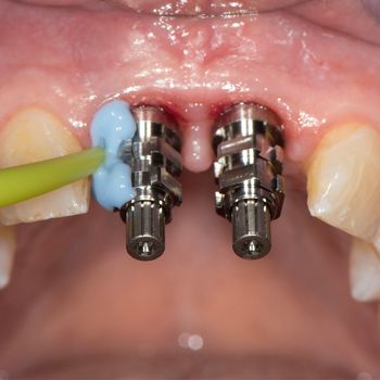 Abb. 18: Klinische Situation 24 Wochen nach Implantation. Offene Abformung mit verschraubten Abformpfosten und individuellem Löffel.