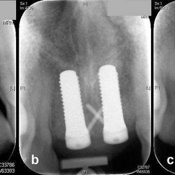 Abb. 2: Radiologische Kontrolle. Ausgangssituation (a), unmittelbar nach Implantation (b) und unmittelbar nach Einsetzen der verschraubten Keramikkronen.