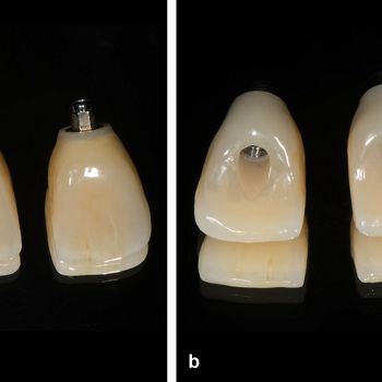 Abb. 20: Verschraubte Keramikkronen. Ansicht von vestibulär (a) und palatinal (b), Zahntechnik: Held Zahntechnik, Gossau, CH.