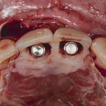 Abb. 6: Prothetisch orientierte Positionierung der Implantate mit Hilfe einer palatinal ausgeschliffenen Orientierungsschablone.