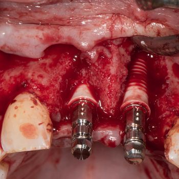 Abb. 7: Intraoperativer Situs nach Insertion von zwei zweiteiligen Keramikimplantaten mit Transferteilen aus Metall (Straumann Pure Ceramic Implant, Institut Straumann AG).