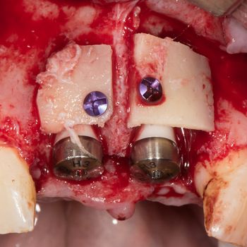 Abb. 8: Intraoperativer Situs nach Befestigung von zwei autologen Knochenblöcken mit Osteosyntheseschrauben.