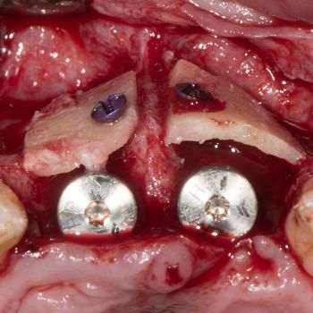 Abb. 9: Intraoperativer Situs nach Befestigung von zwei autologen Knochenblöcken mit Osteosyntheseschrauben.