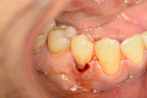 Ausgangssituation vor Extraktion von Zahn 44