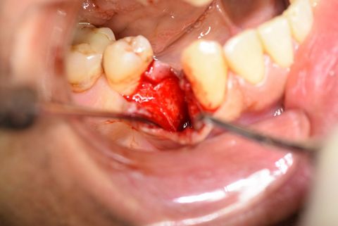 Situation nach Zahnextraktion von Zahn 44