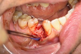 Auffüllen der Alveole mit maxgraft® Granulat