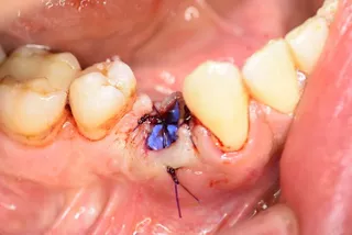Passive Adaptation der Membran mittels Nähten, offene Einheilung von permamem®