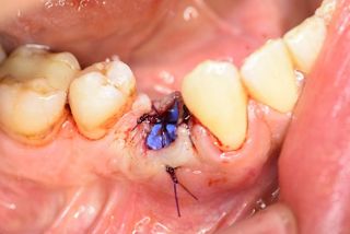 Passive Adaptation der Membran mittels Nähten, offene Einheilung von permamem®