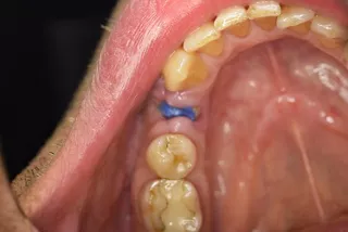 Abgeheilte Alveole 11 Tage postoperativ