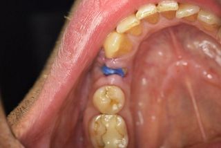 Abgeheilte Alveole 11 Tage postoperativ