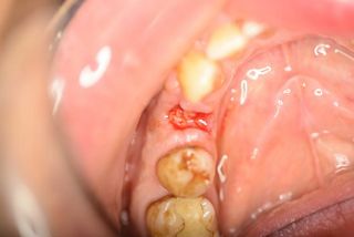  Membranentfernung 21 Tage postoperativ