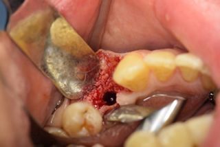 Präparation des Implantatbetts nach Re-Entry 