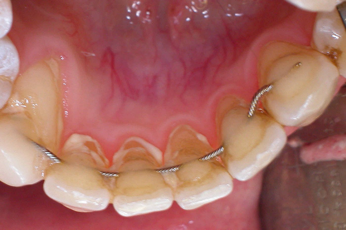 Abb. 3: verseilter Retainer, schlechte Mundhygiene