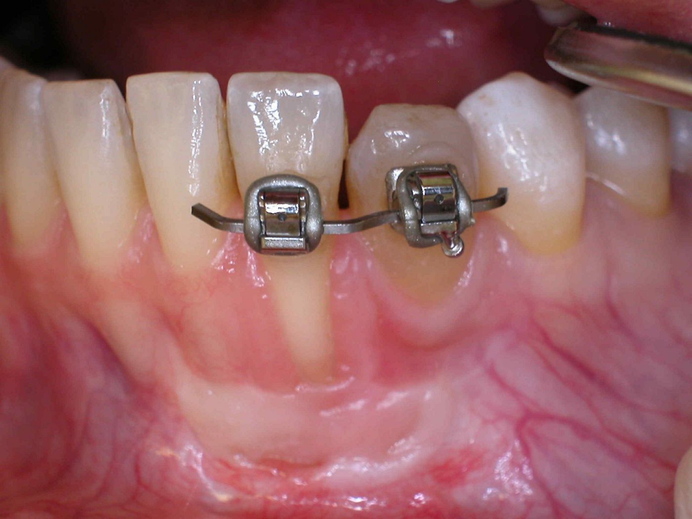 Abb. 9: kieferorthopädische Vorbehandlung