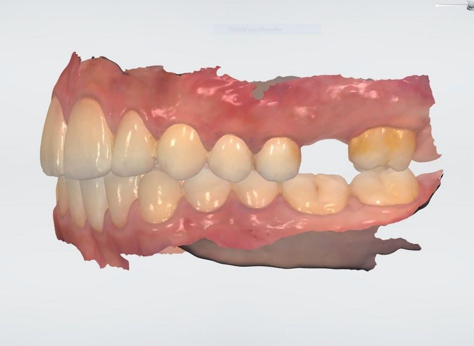 Abb. 2: Der aus dem intraoralen Scan erstellte Screenshot (Ausschnitt) zeigt eine stabile Verzahnung. 