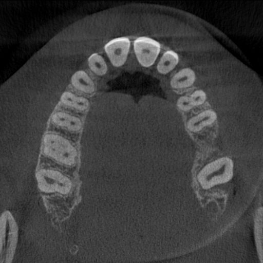 Abb. 3: Das DVT zeigt an Position 26 auf Höhe der zukünftigen Implantatschulter eine relativ breite Knochenbasis.