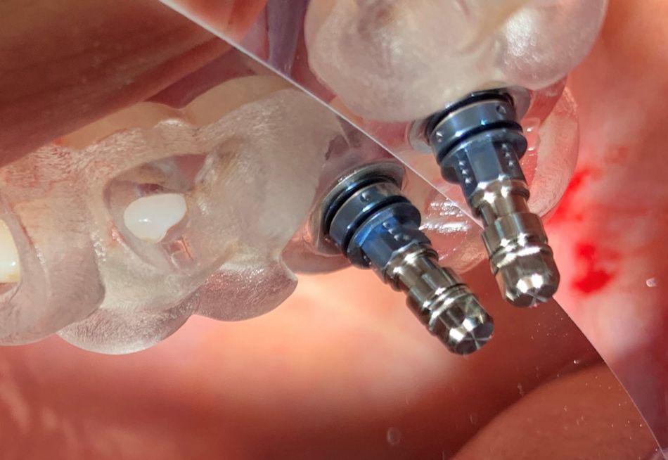 Abb. 7: Nach Stanzung der Alveolarmukosa und geführter Aufbereitung wird das Implantat in seine Endposition gebracht (Aufnahme über Spiegel). Links ist ein Sichtfenster zur Positionskontrolle der gedruckten Schablone erkennbar.